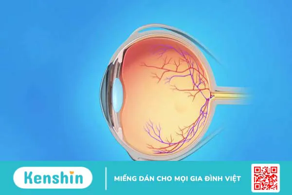 Phù võng mạc là gì? Biểu hiện, nguyên nhân và giải pháp 1