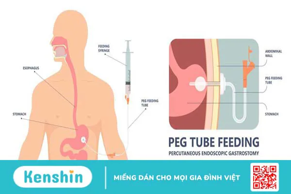 Phúc mạc là gì? Nguyên nhân gây viêm phúc mạc 5