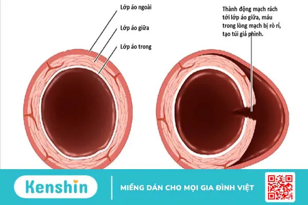 Giả phình động mạch do thông tim 1