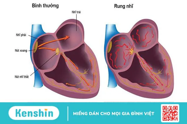 Phương pháp điều trị thay thế thuốc cho rung nhĩ hiện nay 1