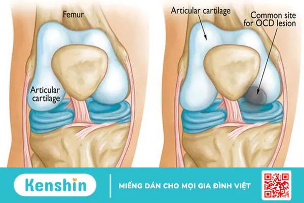 Viêm xương sụn bóc tách và những điều cần biết 2