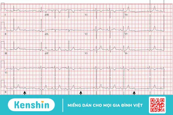 Phương pháp đo ECG là gì? Nguyên lý và quy trình các bước đo ECG 2