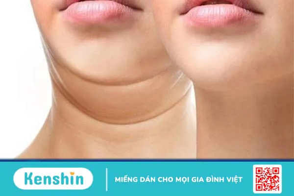 Phương pháp tiêm tan mỡ nọng cằm: Cơ chế, quá trình thực hiện và tác dụng phụ 2