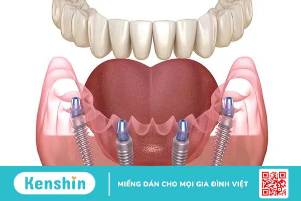 Phương pháp trồng răng All on 4: Tổng quan, ưu điểm và quy trình cấy ghép 1