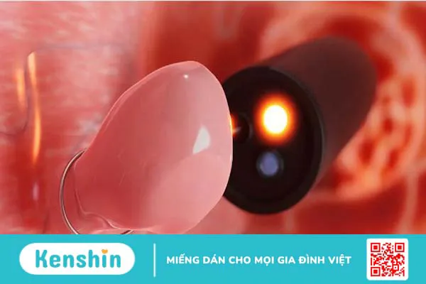 Polyp đại tràng nghịch sản và những điều cần biết -1