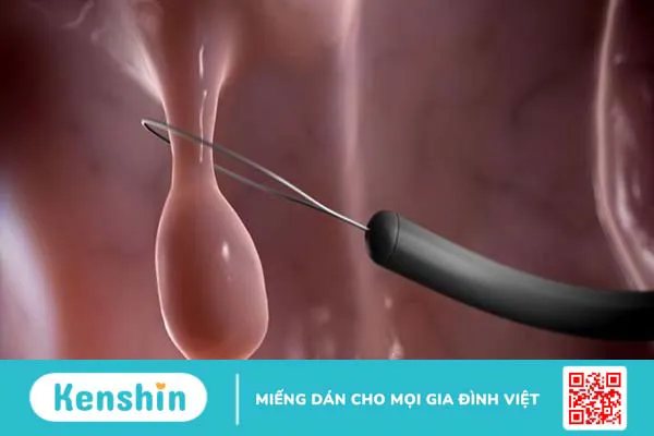 Polyp đại tràng nghịch sản và những điều cần biết -3