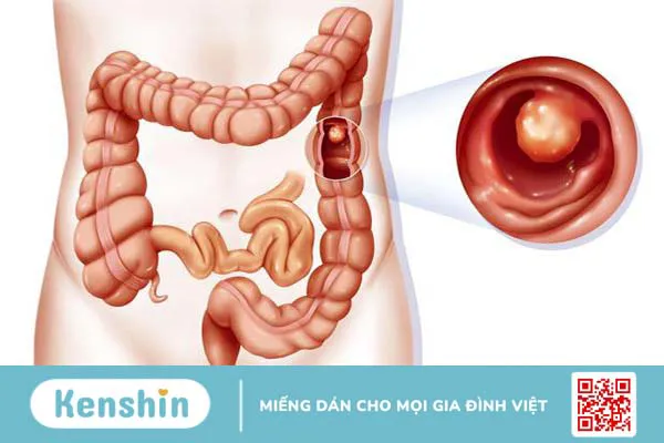 Polyp loạn sản đại tràng, nguyên nhân và cách điều trị.