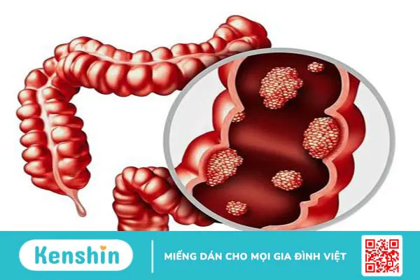 Polyp loạn sản đại tràng, nguyên nhân và cách điều trị.