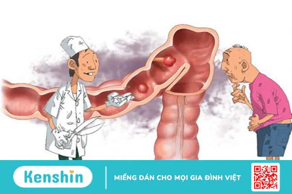 Polyp loạn sản đại tràng, nguyên nhân và cách điều trị.