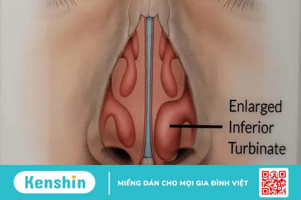 Quá phát cuốn mũi và những điều cần biết