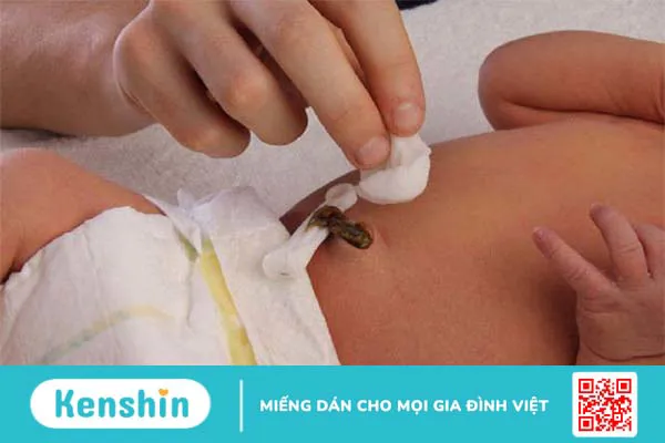 Quá trình rụng rốn ở trẻ sơ sinh và các vấn đề bố mẹ cần cảnh giác 3