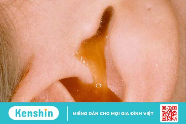 Rạch chích mủ màng nhĩ trị bệnh viêm tai giữa 1