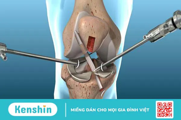 Rách dây chằng là do đâu và dấu hiệu nhận biết thế nào? 3