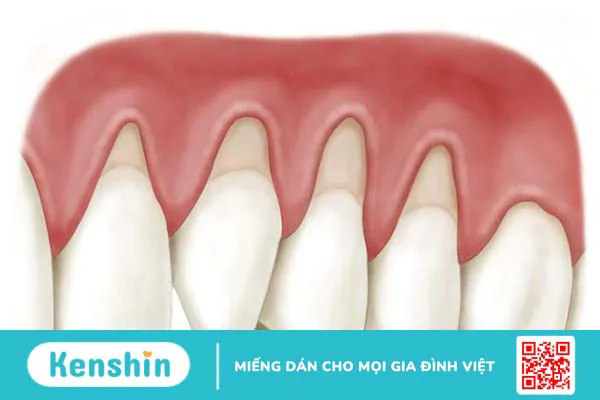 Rách lợi chân răng khắc phục như thế nào?