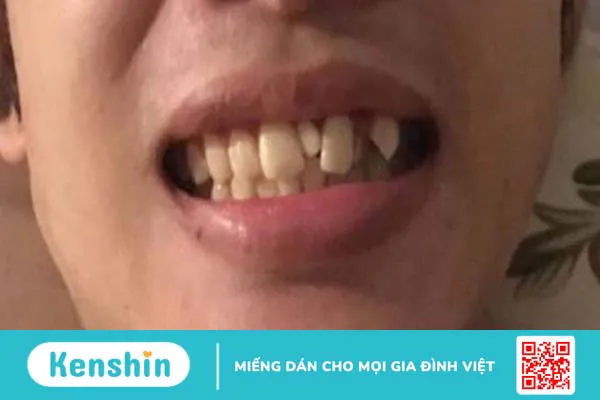 Răng kẹ và những ảnh hưởng của răng kẹ 1