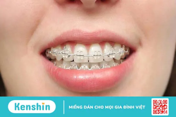 Răng kẹ và những ảnh hưởng của răng kẹ 3