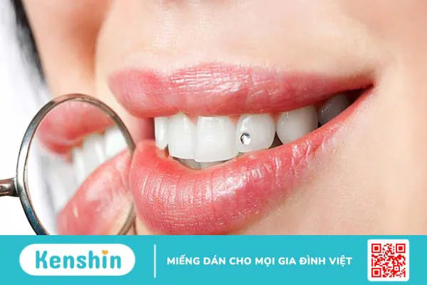 Răng kim cương là gì? Ưu điểm và quy trình gắn răng kim cương 1