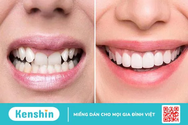 Răng sứ bị đen phải làm sao? Can thiệp thế nào cho phù hợp?  1