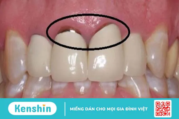 Răng sứ bị đen phải làm sao? Can thiệp thế nào cho phù hợp? 3  1