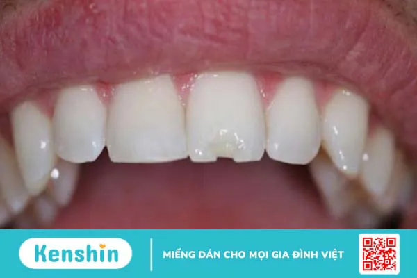 Răng sứ bị mẻ: Nguyên nhân, ảnh hưởng và cách phòng tránh 1