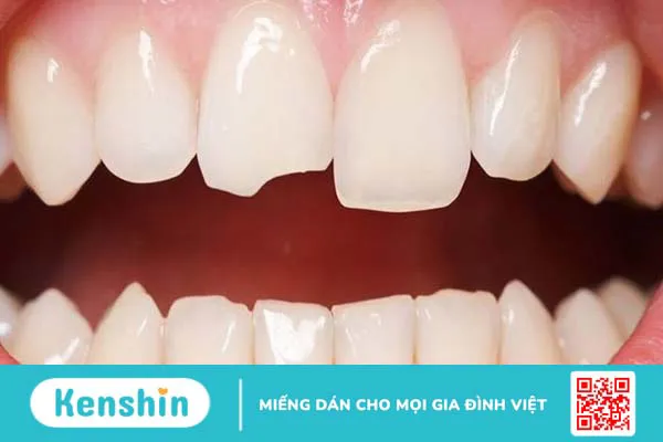 Răng sứ bị mẻ: Nguyên nhân, ảnh hưởng và cách phòng tránh 2