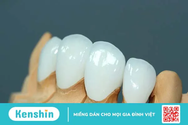 Răng sứ emax: Tổng quan, phân loại và ứng dụng trong nha khoa 1