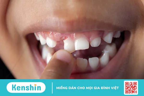 Răng sứ emax: Tổng quan, phân loại và ứng dụng trong nha khoa 4