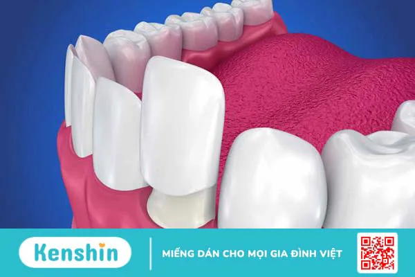 Răng sứ kim cương là gì? Ưu và nhược điểm của loại răng này 1