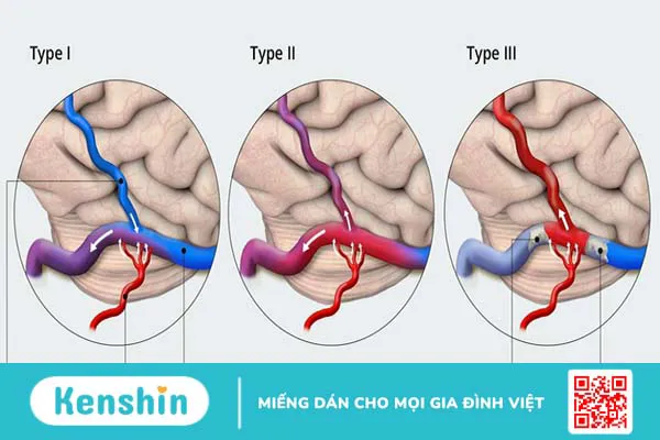 Rò động tĩnh mạch màng cứng là gì? Nguyên nhân và dấu hiệu của rò động tĩnh mạch màng cứng 1