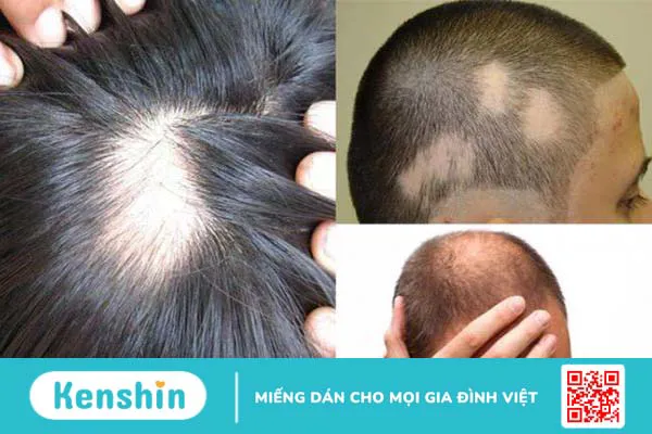 Rụng tóc do bệnh da đầu nên làm gì 2