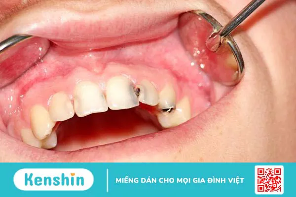 Sâu kẽ răng cửa: Nguyên nhân và cách điều trị 1