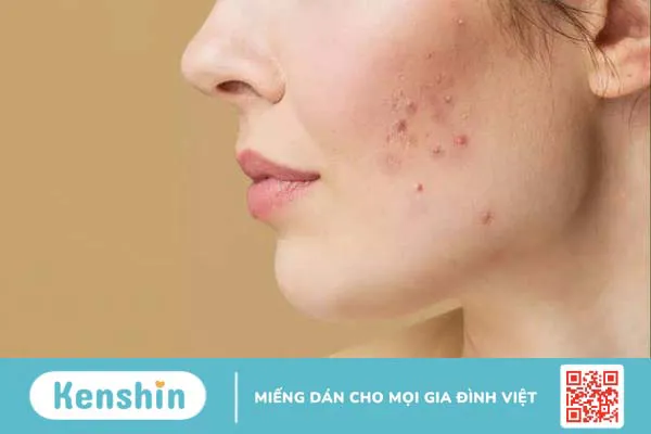 Nặn mụn xong có nên bôi kem chống nắng không là thắc mắc của nhiều người