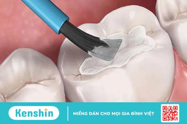 Sealant là gì? Phương pháp thực hiện và những ưu điểm 1