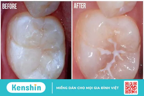 Sealant là gì? Phương pháp thực hiện và những ưu điểm 3