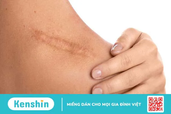 Sẹo trắng là gì? Phòng ngừa sẹo như thế nào? 1