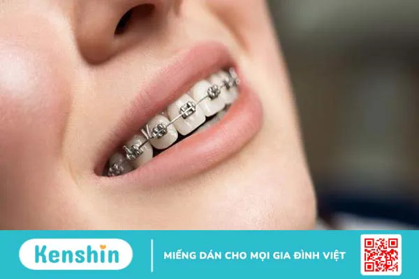 So sánh niềng răng mắc cài kim loại thường và tự buộc 2