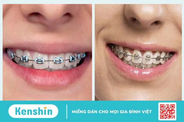 So sánh niềng răng mắc cài kim loại thường và tự buộc 1