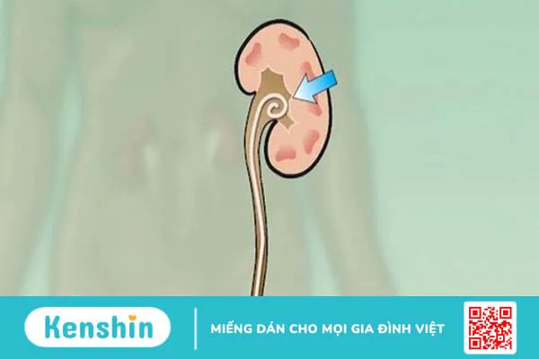 Sonde JJ niệu quản là gì? Rút ống JJ niệu quản có đau không? 4