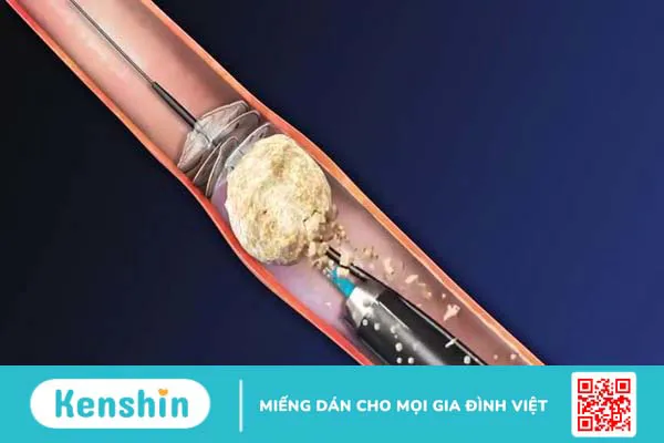 Sonde JJ niệu quản là gì? Rút ống JJ niệu quản có đau không? 2