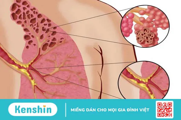 Sử dụng thuốc lá điện tử có gây ung thư không? 4