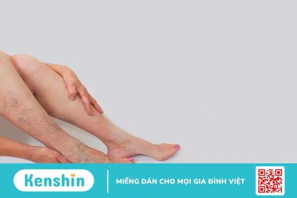 Suy giãn tĩnh mạch kiêng ăn gì? Các thực phẩm được khuyên dùng cho người bệnh 1