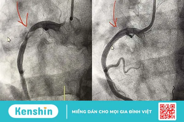 Giải đáp về tác động và độ an toàn của stent phủ thuốc 2