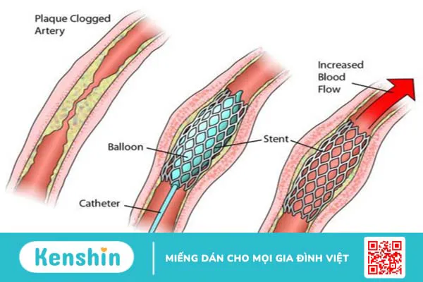 Giải đáp về tác động và độ an toàn của stent phủ thuốc 3