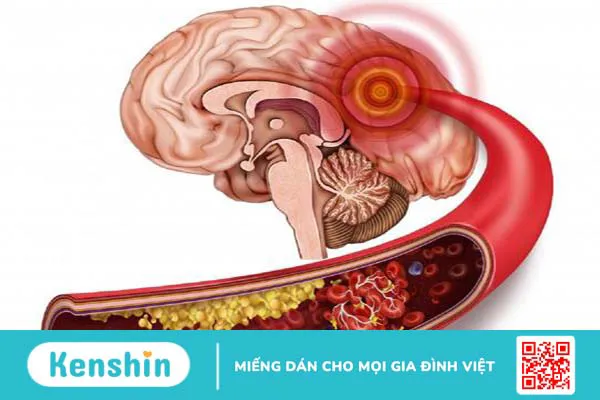 Tắc mạch máu não uống thuốc gì thì tốt cho người bệnh? -1