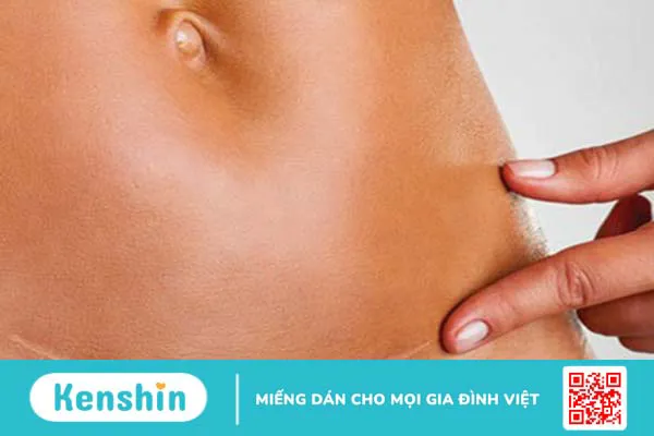 Tại sao cùng sinh mổ, người bị sẹo xấu, người lại không? 1