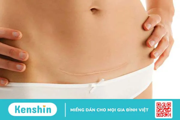 Tại sao cùng sinh mổ, người bị sẹo xấu, người lại không? 2