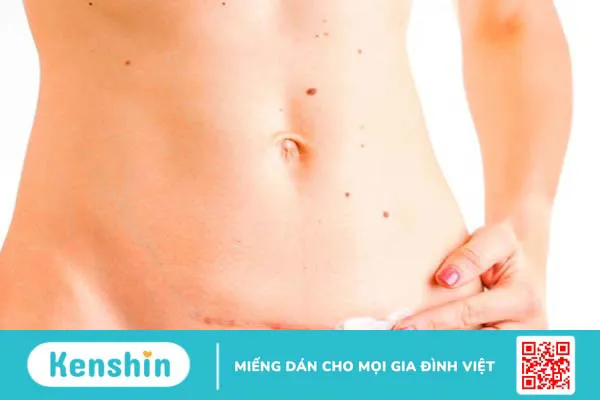 Tại sao cùng sinh mổ, người bị sẹo xấu, người lại không? 3