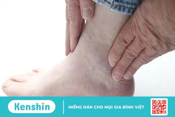 Tại sao đái tháo đường gây suy thận? Biến chứng trên thận có nguy hiểm không? 4