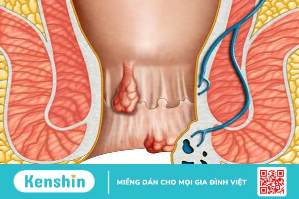 Lý do gây ra tình trạng đi ngoài ra máu đông 1