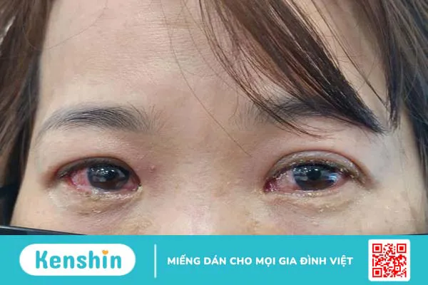 Người bị đau mắt đỏ không nên ăn xôi